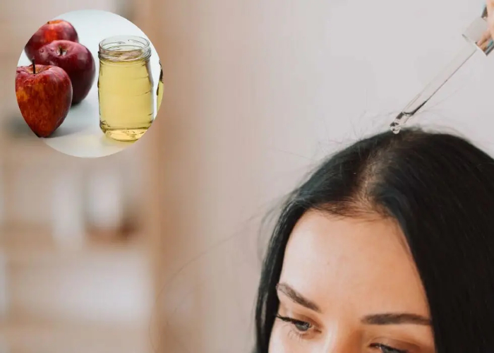 درمان شوره سر با سرکه سیب